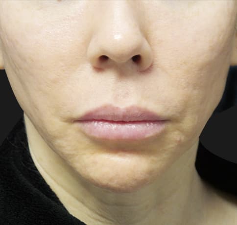 Case 44767, Performed By Dr. Tehrani – Before