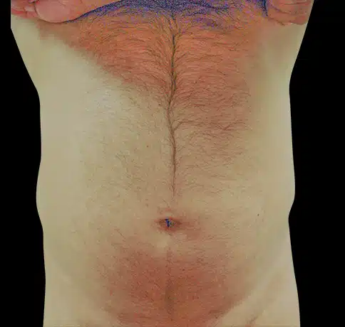 Case 8544, Performed By Dr. Tehrani – Before