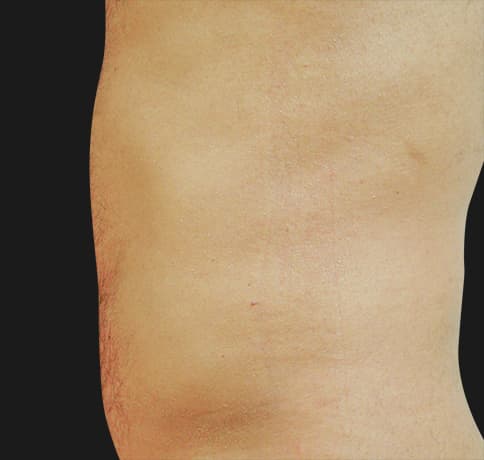 Case 8544, Performed By Dr. Tehrani – After