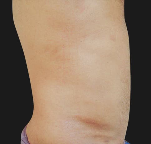 Case 8544, Performed By Dr. Tehrani – angle 3 After