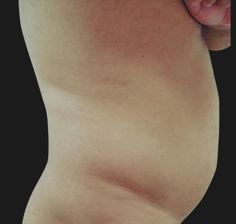 Case 8544, Performed By Dr. Tehrani – angle 3 Before