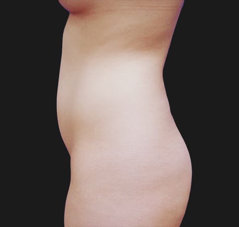 Case 8052, Performed By Dr. Tehrani – angle 3 Before