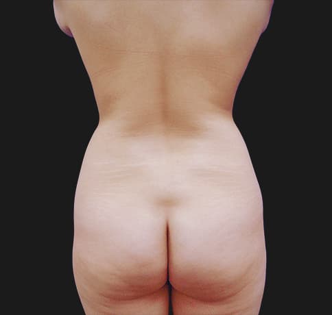 Case 8052, Performed By Dr. Tehrani – angle 4 Before