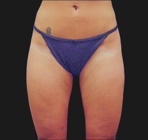 Case 6784, Performed By Dr. Tehrani – After