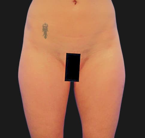 Case 6784, Performed By Dr. Tehrani – Before