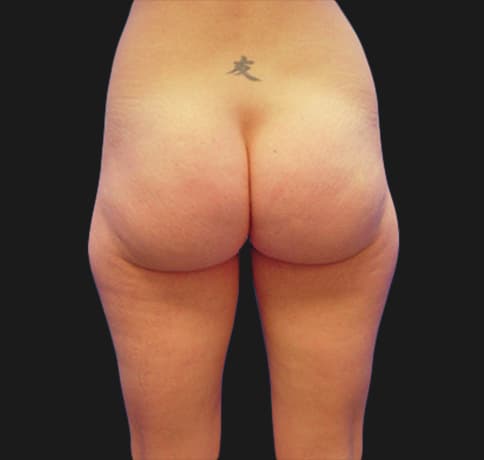 Case 6784, Performed By Dr. Tehrani – angle 4 Before