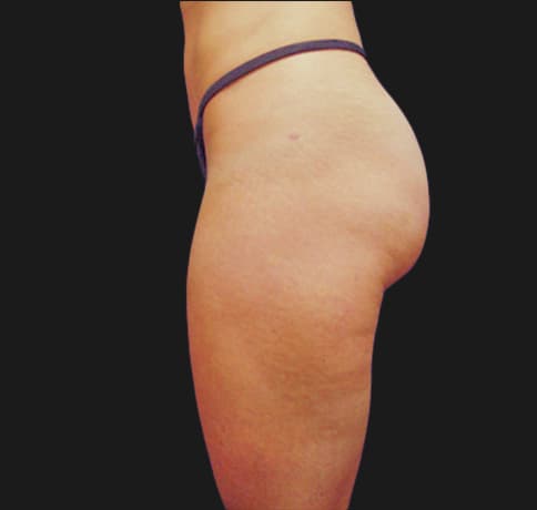 Case 6784, Performed By Dr. Tehrani – angle 3 After