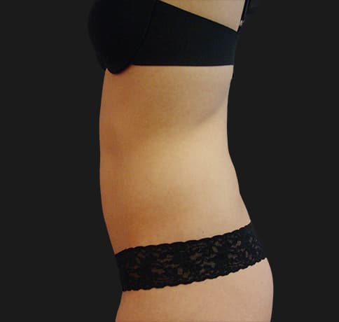 Case 8800, Performed By Dr. Tehrani – angle 3 Before
