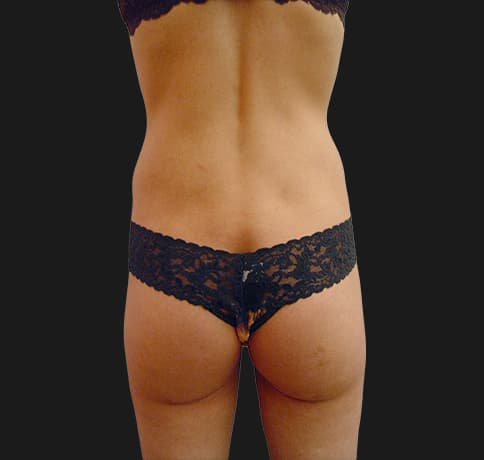 Case 8800, Performed By Dr. Tehrani – angle 4 After