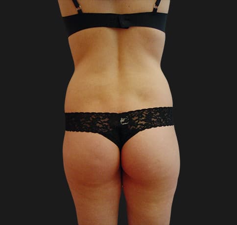 Case 8800, Performed By Dr. Tehrani – angle 4 Before