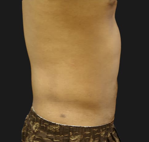 Case 10689, Performed By Dr. Tehrani – After
