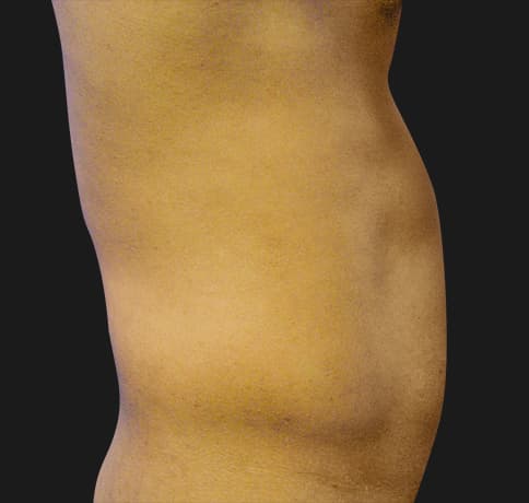 Case 10689, Performed By Dr. Tehrani – Before