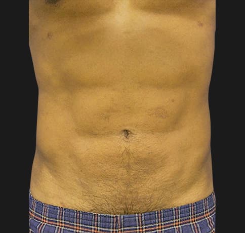 Case 10689, Performed By Dr. Tehrani – After