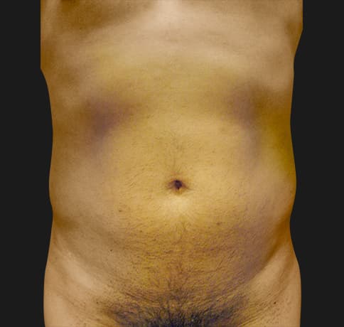 Case 10689, Performed By Dr. Tehrani – Before