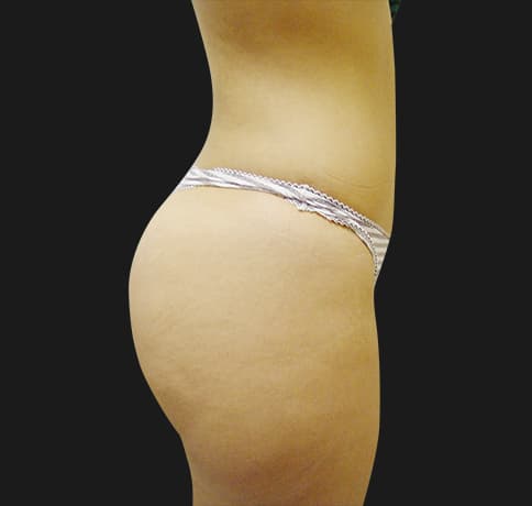 Case 7582, Performed By Dr. Tehrani – angle 2 After