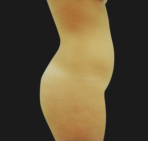 Case 7582, Performed By Dr. Tehrani – angle 2 Before
