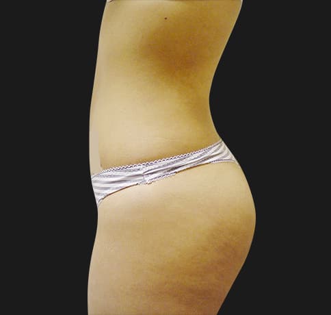 Case 7582, Performed By Dr. Tehrani – angle 3 After