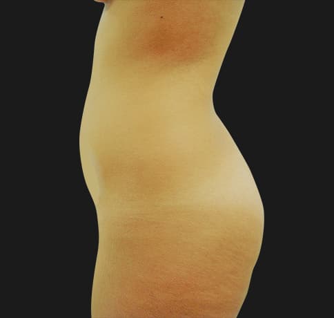 Case 7582, Performed By Dr. Tehrani – angle 3 Before