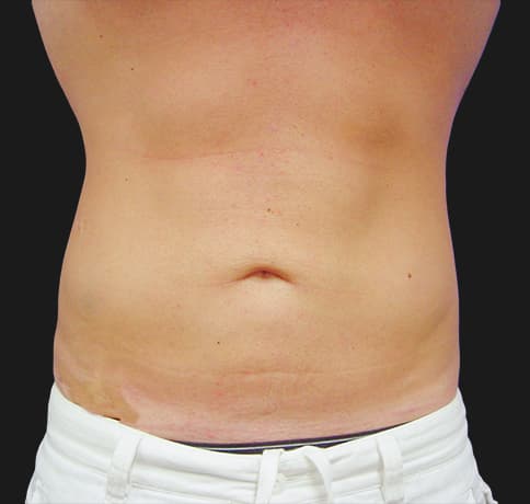 Case 3187, Performed By Dr. Tehrani – After