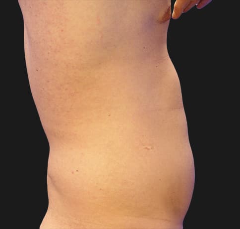 Case 3187, Performed By Dr. Tehrani – Before