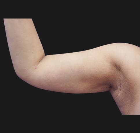 Case 28730, Performed By Dr. Tehrani – After