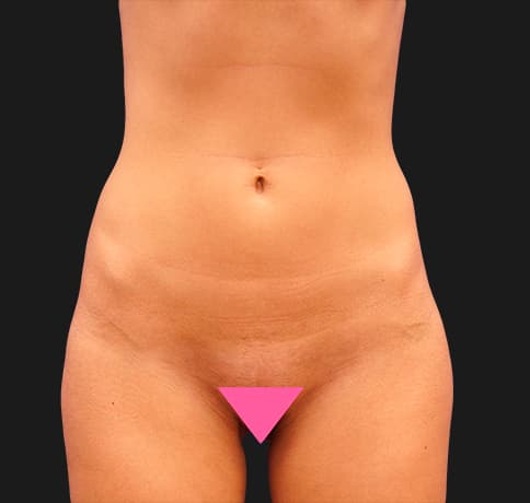 Case 29067, Performed By Dr. Tehrani – Before