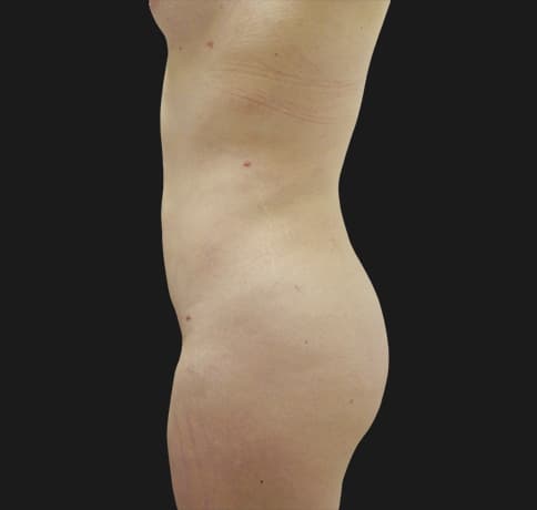 Case 30513, Performed By Dr. Tehrani – angle 2 After