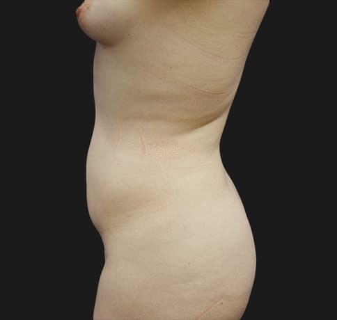 Case 30513, Performed By Dr. Tehrani – angle 2 Before