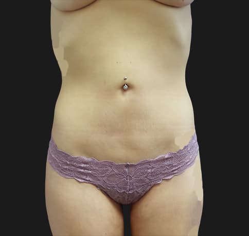 Case 29420, Performed By Dr. Tehrani – After