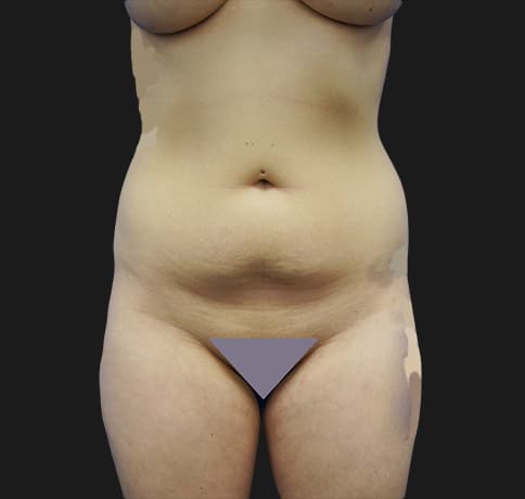 Case 29420, Performed By Dr. Tehrani – Before