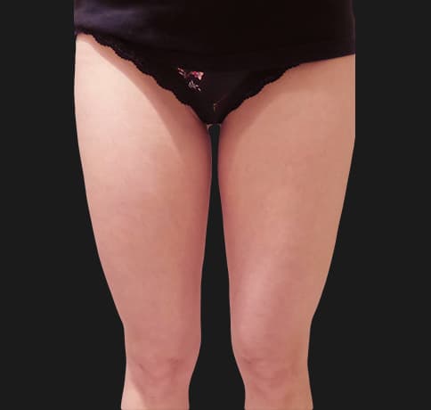 Case 39343, Performed By Dr. Tehrani – After