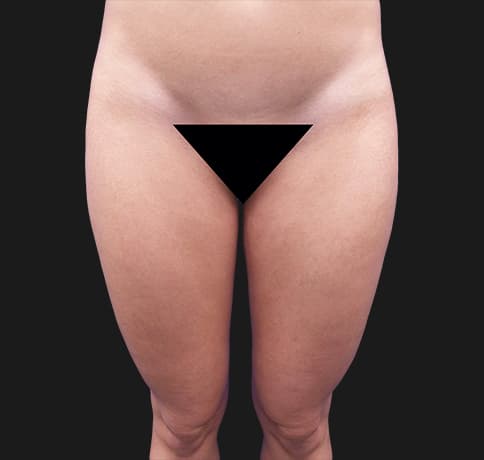 Case 39343, Performed By Dr. Tehrani – Before