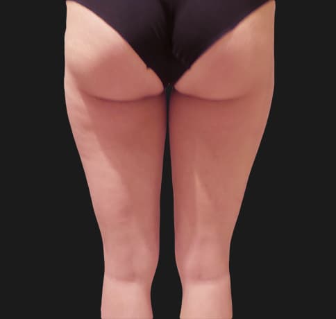 Case 39343, Performed By Dr. Tehrani – angle 3 After