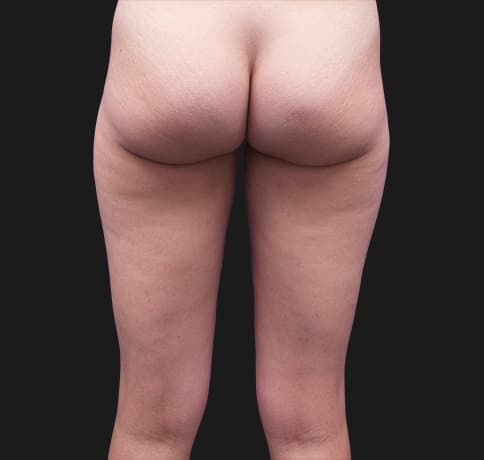 Case 39343, Performed By Dr. Tehrani – angle 3 Before