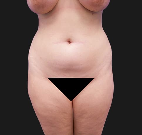 Case 38212, Performed By Dr. Tehrani – Before