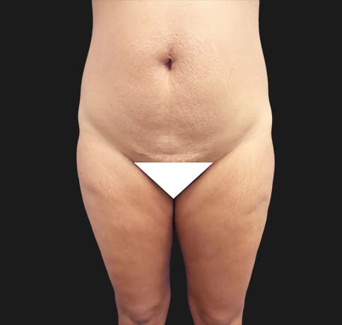 Case 37455, Performed By Dr. Tehrani – After