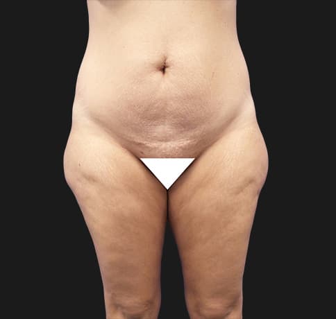 Case 37455, Performed By Dr. Tehrani – Before