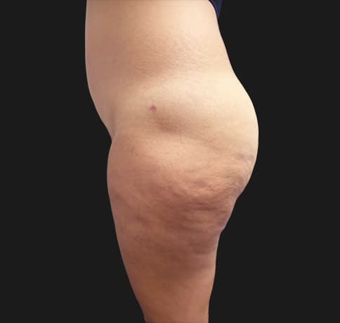 Case 37455, Performed By Dr. Tehrani – angle 3 After