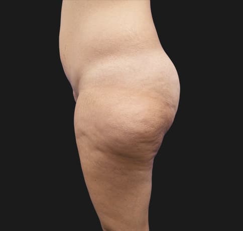 Case 37455, Performed By Dr. Tehrani – angle 3 Before