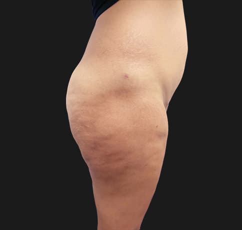 Case 37455, Performed By Dr. Tehrani – After