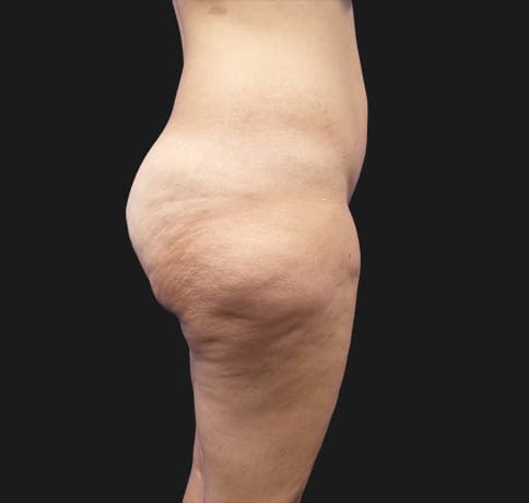 Case 37455, Performed By Dr. Tehrani – Before
