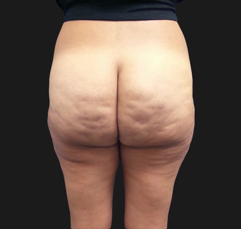 Case 37455, Performed By Dr. Tehrani – angle 4 After