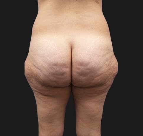 Case 37455, Performed By Dr. Tehrani – angle 4 Before