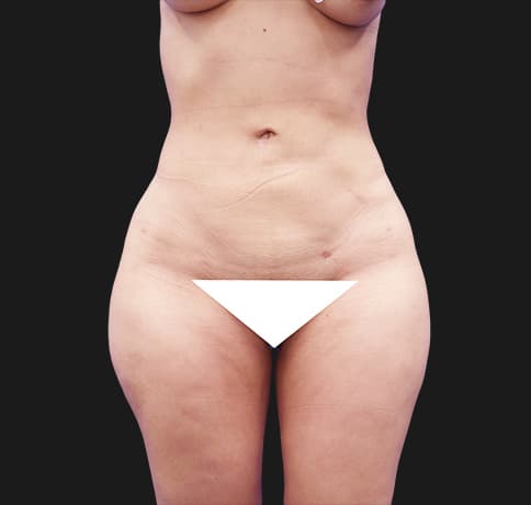 Case 41224, Performed By Dr. Tehrani – After