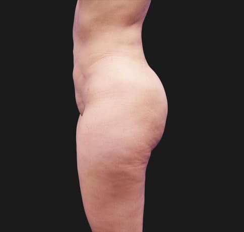 Case 41224, Performed By Dr. Tehrani – angle 3 After