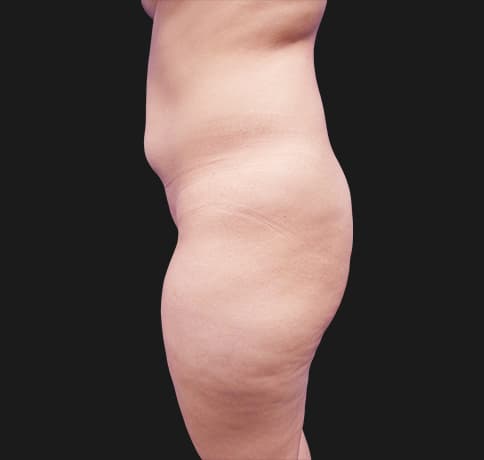 Case 41224, Performed By Dr. Tehrani – angle 3 Before