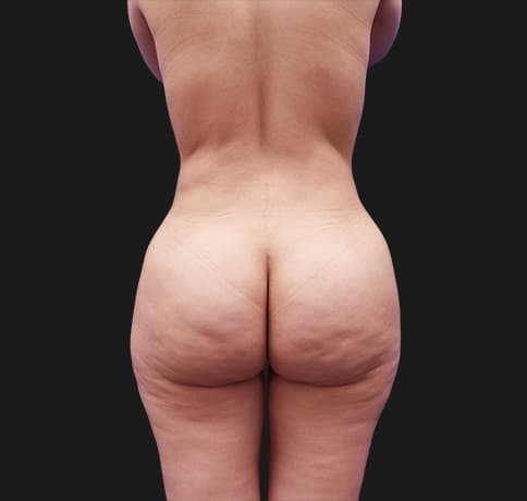 Case 41224, Performed By Dr. Tehrani – angle 4 After