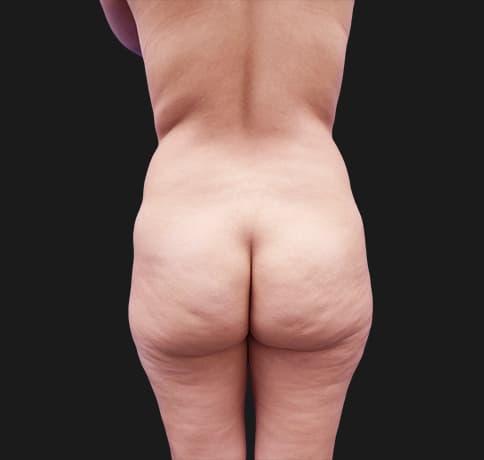 Case 41224, Performed By Dr. Tehrani – angle 4 Before