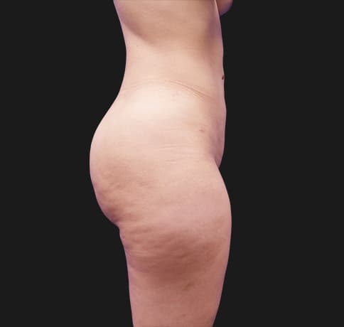 Case 41224, Performed By Dr. Tehrani – After