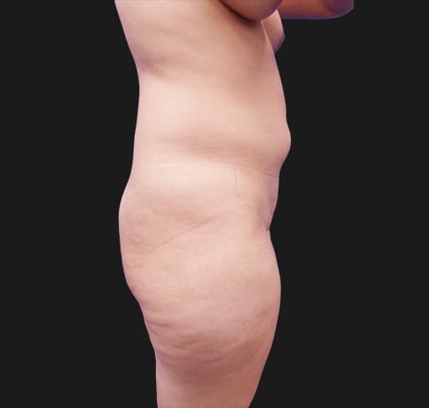 Case 41224, Performed By Dr. Tehrani – Before